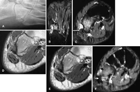 A—F Case 3. A Dorsoplantar oblique radiograph of the right foot. A... | Download Scientific Diagram