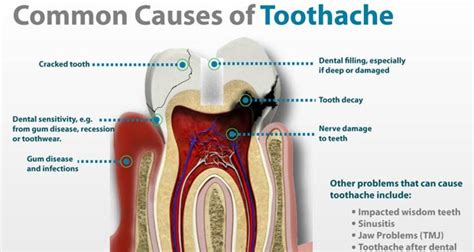 Reasons for Tooth Pain - Melbourne Periocare