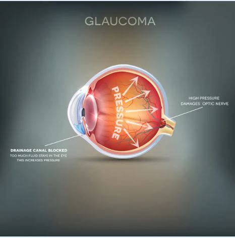 Open-Angle Glaucoma Symptoms - Grosinger, Spigelman & Grey