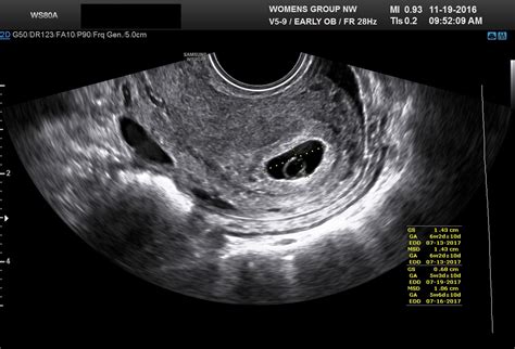 Gestational Sac Measurement Ultrasound