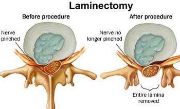 Bilateral Foraminal Stenosis Between C5 - C6 Vertebra - Rxharun