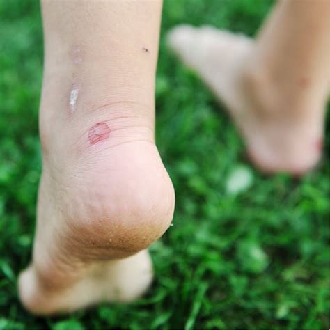 Infected Blister On Top Of Foot Factory Sale | emergencydentistry.com