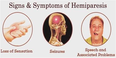 Hemiparesis - Assignment Point