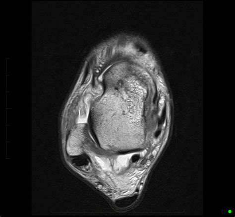 mri-ankle-anterior-talofibular-ligament-rupture-3 - MRI at Melbourne Radiology Clinic