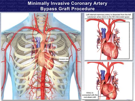 Coronary Artery Bypass Graft