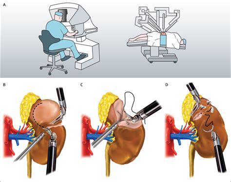 Renal cancer - The Lancet