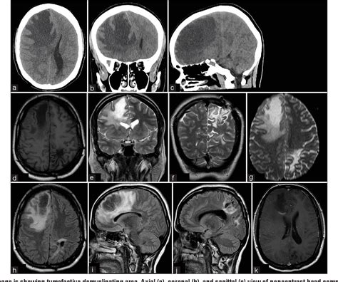 Figure 1 from Management of Recurrent Tumefactive Multiple Sclerosis ...