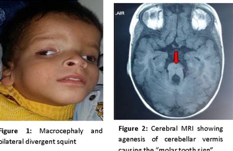 Joubert Syndrome: A Rare Developmental Disorder of Brain - MEDizzy