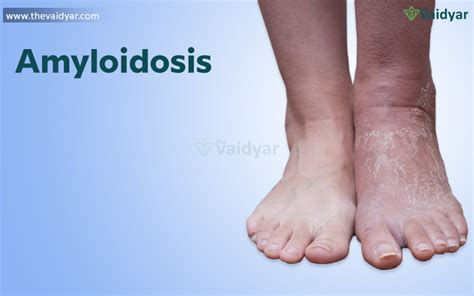 Symptoms Of Amyloidosis