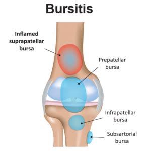 Bursitis vs Arthritis: What Is the Difference? | Carolinas Pain Center