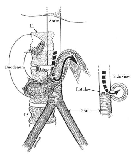 Drawing of aortoenteric fistula at the anastomosis of the abdominal... | Download Scientific Diagram