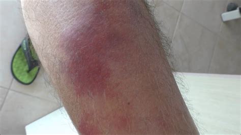 Cellulitis on a patient's shin before and 4 days after treatment - YouTube