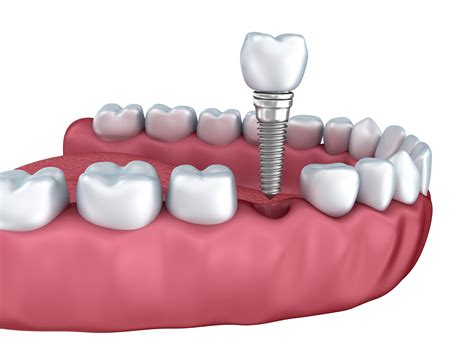 What To Do If You Have A Dental Implant Infection