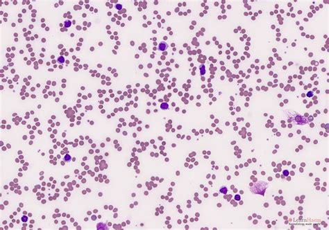 Marginal Zone Lymphoma - LearnHaem | Haematology Made Simple