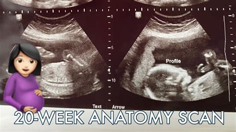 Anatomy Scan 20 weeks BREECH BABY - YouTube