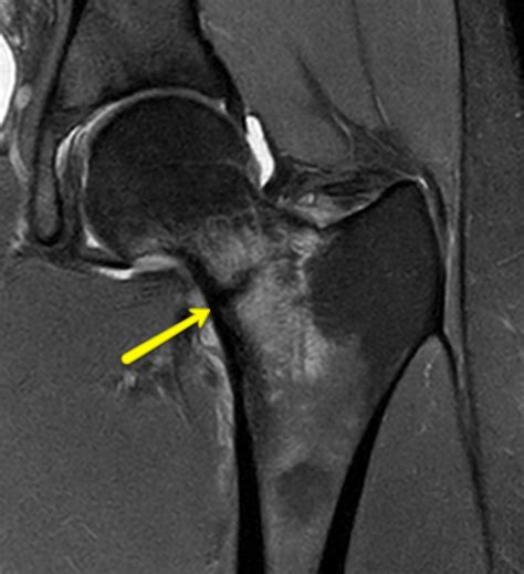 Running with Hip Pain - Femoral Neck Stress Fractures — The Physio Lab