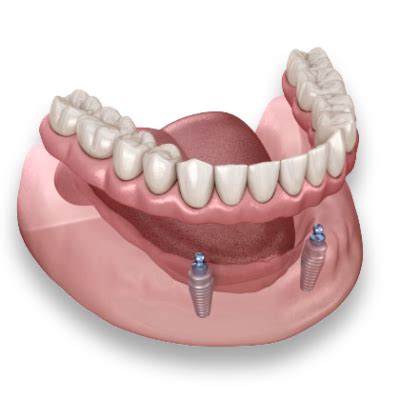 Removable Dentures on Implants - Calgary Denture Clinic - Dentures and Implants