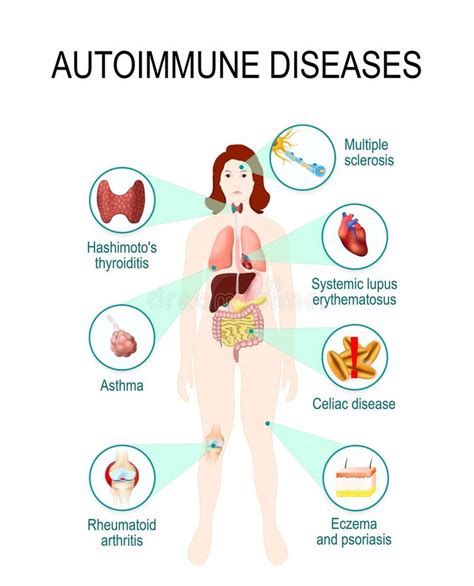 Autoimmunerkrankungen vektor abbildung. Illustration von entzündlich - 95827511