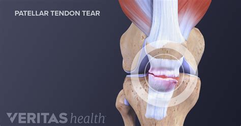 What You Need to Know About Kneecap Injuries