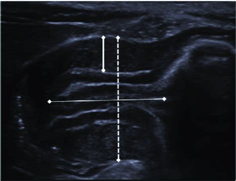 Pyloric ultrasound with pyloric muscle thickness of 5 mm (thick line ...