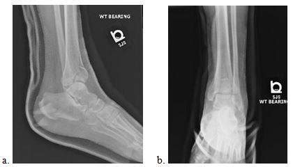 Closed, displaced, intra-articular tibial plafond fracture left ankle.... | Download Scientific ...