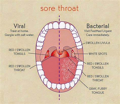 Discovering Joy & Wellness: Difference between Tonsillitis and Sore Throat?