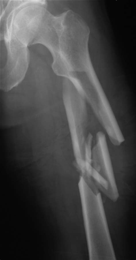 Broken Femur Xray