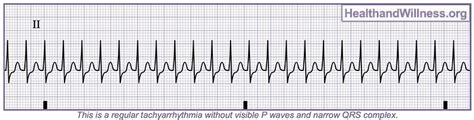 How to Read an EKG Rhythm Strip | Health And Willness