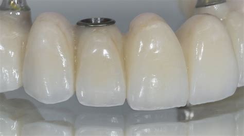 Creating Individual-Looking Teeth On A Full-Arch Bridge | Dental Lab ...