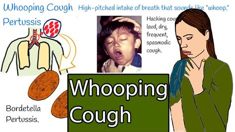 Whooping cough - Pertussis. Hacking cough, Symptoms and treatment - YouTube