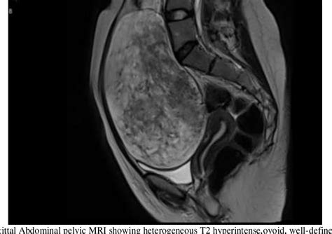 Figure 1 from OVARIAN FIBROMA: A CASE REPORT | Semantic Scholar