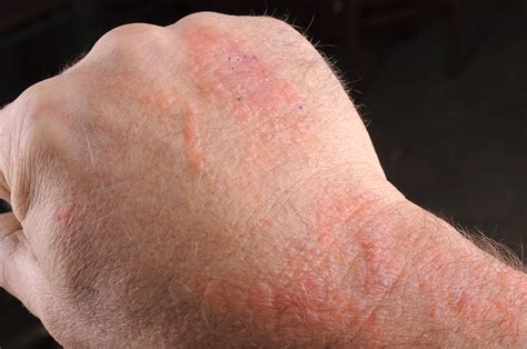 Common Rashes: Causes, Symptoms, and Treatment