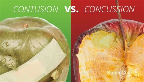 Contusion vs. Concussion: Symptoms, Causes, and Treatment