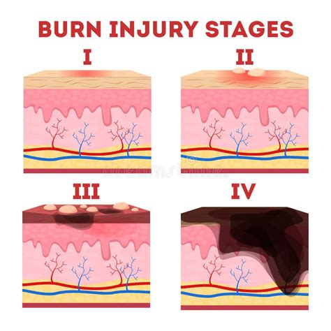 Skin burn classification stock vector. Illustration of medical - 50132291