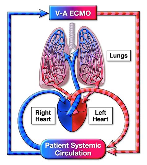 ECMO - Concept Map