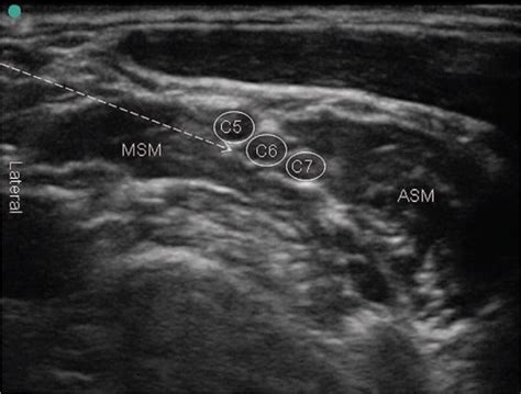 Brachial Plexus Nerve Block