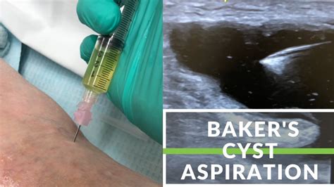 Kidney Cyst Aspiration Procedure