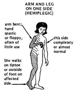 Hemiplegia And Physiotherapy Rehabilitation Exercise Detail in 2021 | Cerebral palsy ...