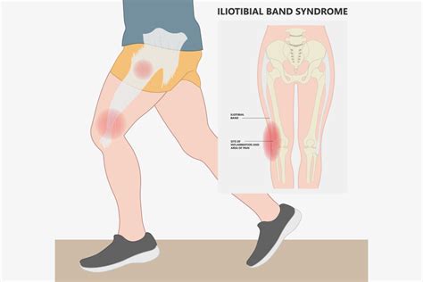 IT Band Syndrome – A Guide to Symptoms, Treatments & Preventions – DMoose