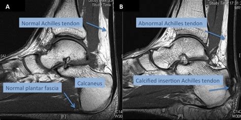 Achilles Tendon Pain | (Non) Insertional Achilles Tendinopathy