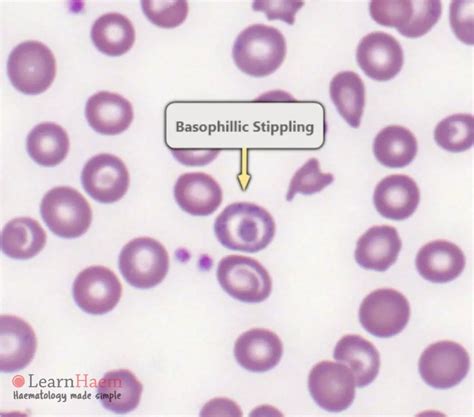 Basophilic Stippling - LearnHaem | Haematology Made Simple