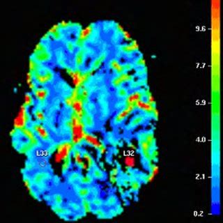 D. Fourteen years after treatment for malignant ependymoma, axial MRI... | Download Scientific ...