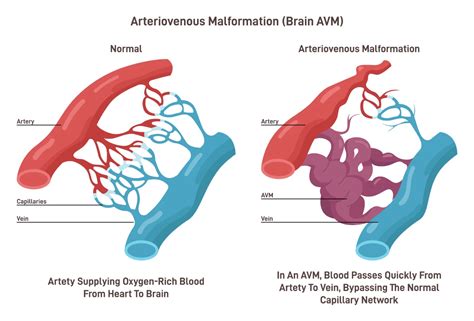 Arteriovenous Malformation (AVM) | Aurora Health Care