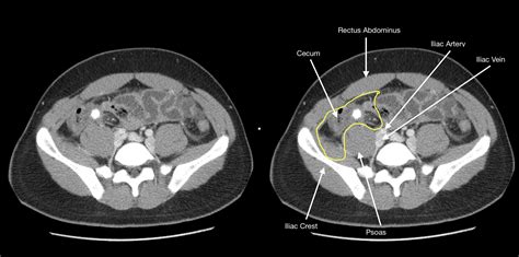 How To Find The Appendix On Imaging - Stepwards