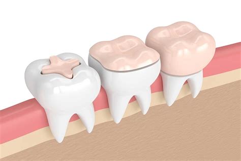 types of dental fillings Tag Archives - Supreme Dentistry