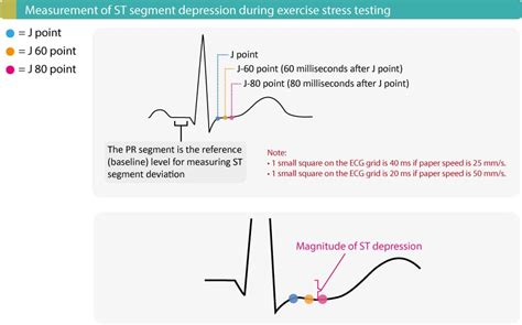 Evaluation of exercise stress test: ECG, symptoms, blood pressure ...