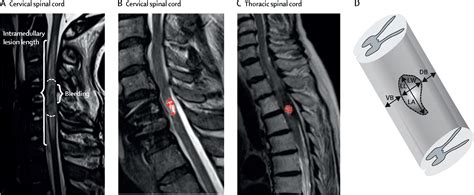 MRI in traumatic spinal cord injury: from clinical assessment to neuroimaging biomarkers - The ...