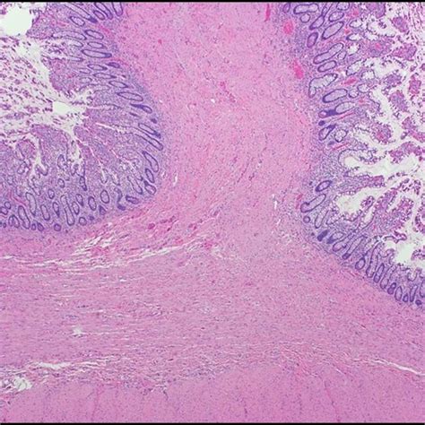 Ileocolic resection showing an edematous terminal ileum with ...