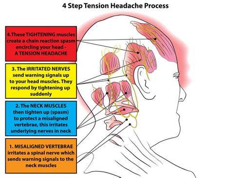 Tension headaches usually affect both sides of the head and last from thirty minutes to several ...