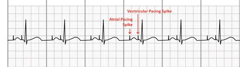 Ventricular Paced Rhythm